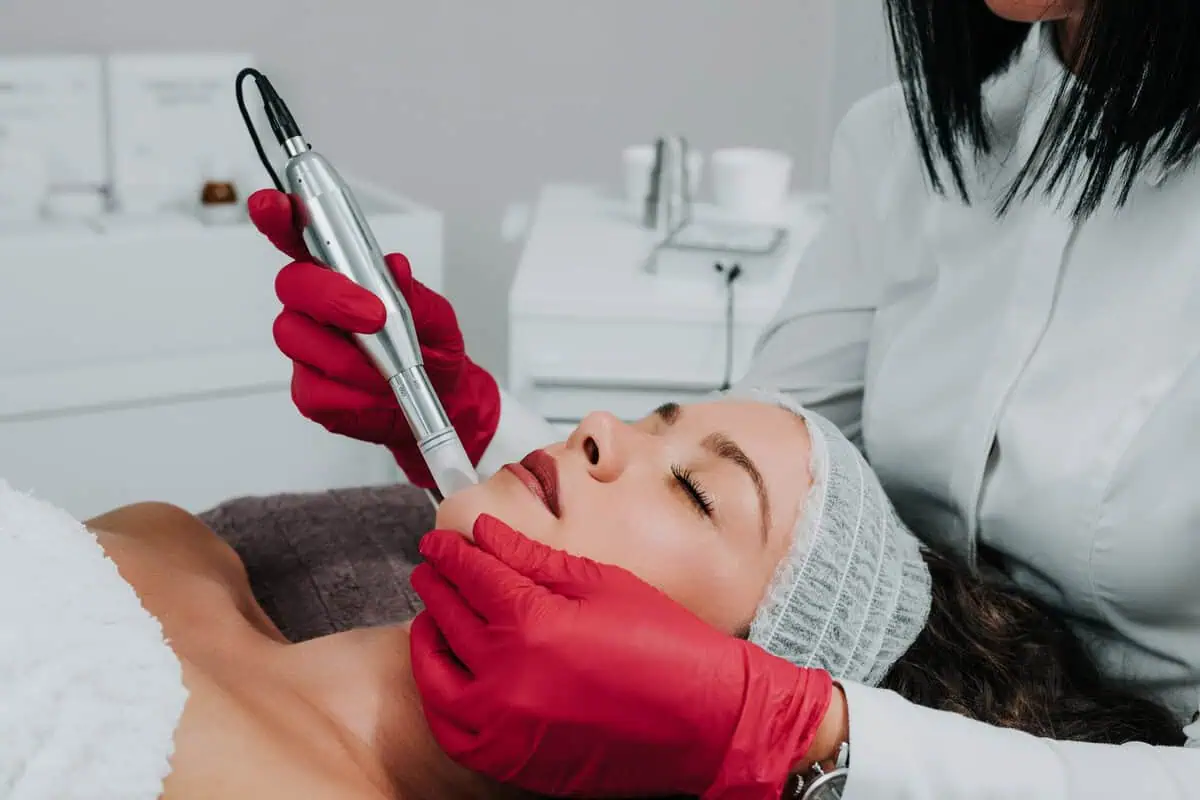 Microneedling Treatment in Miami Lakes, FL