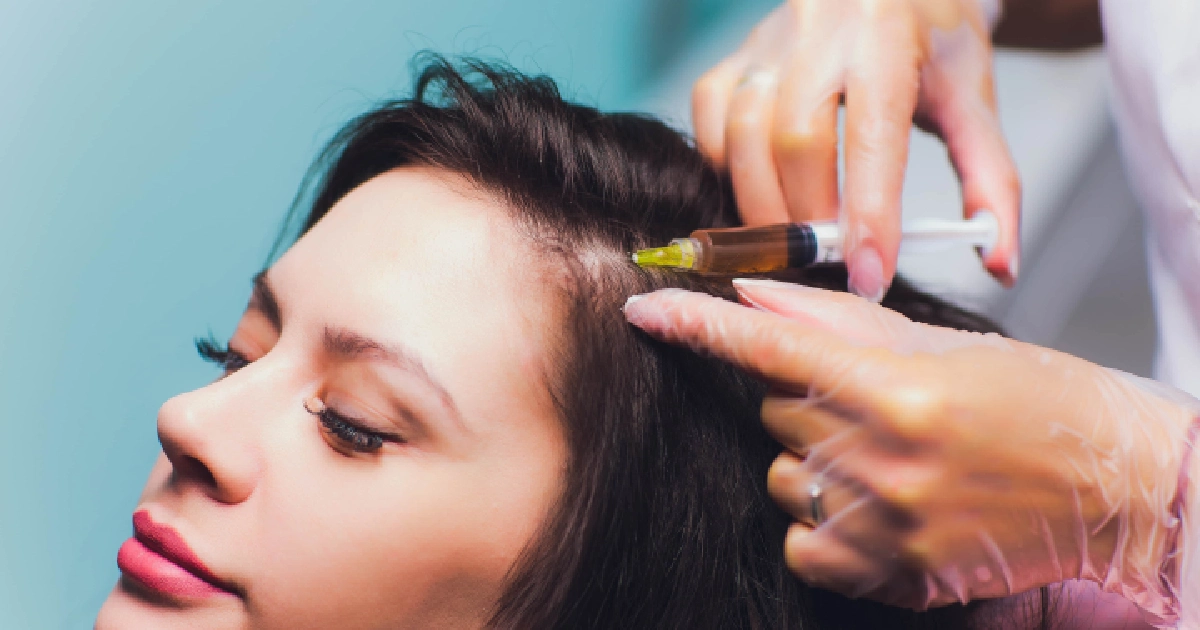 PRP injection administered to a woman’s scalp for hair restoration in Miami Lakes, FL.