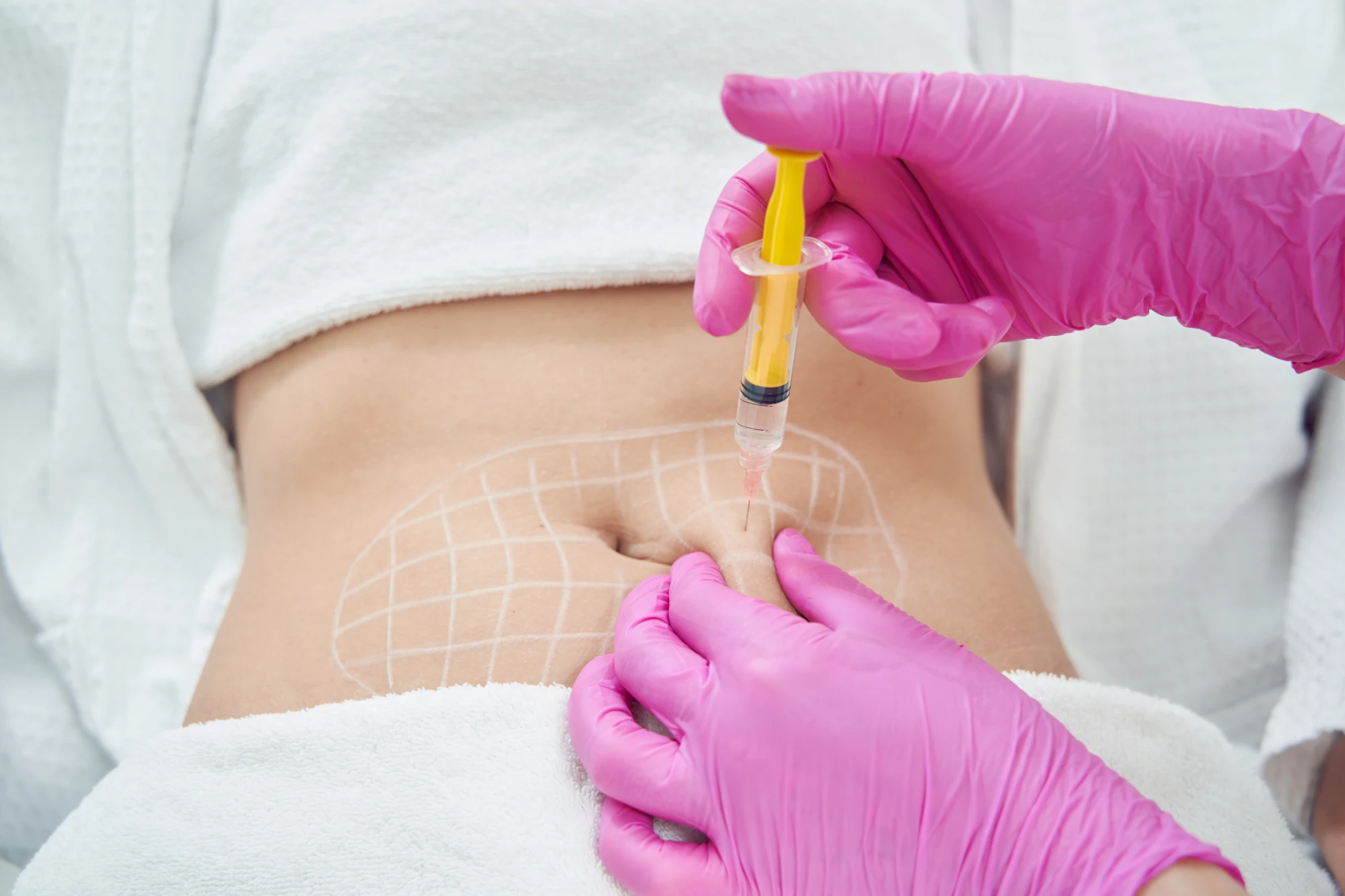 Lipo Dissolve in Miami Lakes FL